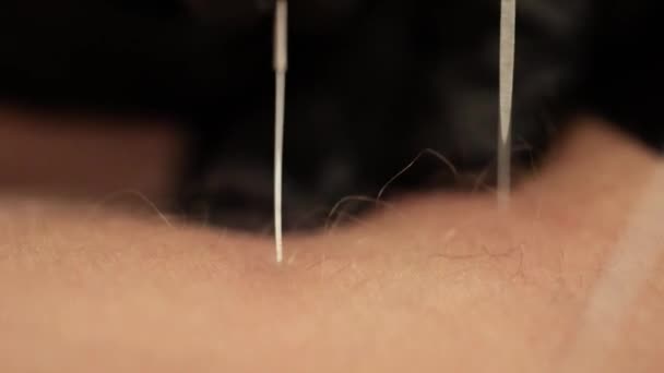 Akupunkteur Sticht Nadel Die Haut Nahaufnahme Mit Zwei Nadeln — Stockvideo
