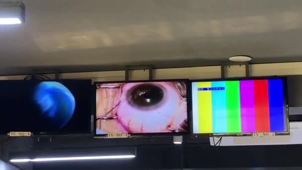 Live Eye Chirurgie Wordt Weergegeven Monitoren Opknoping Van Het Plafond — Stockvideo