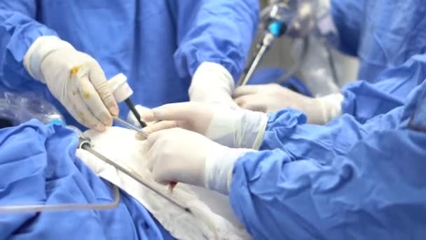 腹腔镜下外科医生在病人腹部穿孔器械 — 图库视频影像