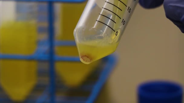 A vérlemezkék expozíciója a steril kúpos cső alján, a plazmától és a vértől elkülönítve egy laborban - PRP és őssejt-folyamat