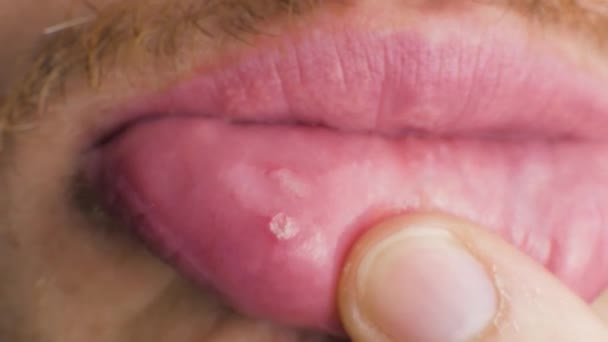 Eine Mundschleimhautentzündung Auf Dem Zahnfleisch Schliessen — Stockvideo