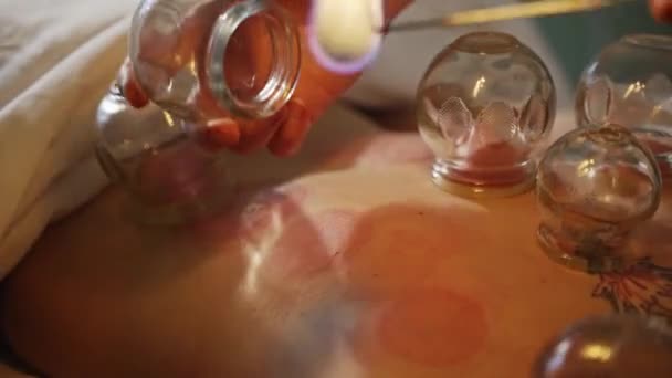 Therapist Applying Cupping Suction Cups Patients Back Slow Motion — Stockvideo
