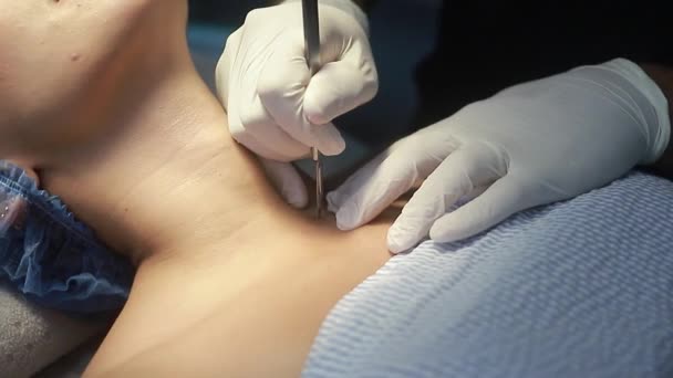 Arzt Mit Patient Der Eine Kleine Zyste Operationssaal Operiert Geschlossenes — Stockvideo