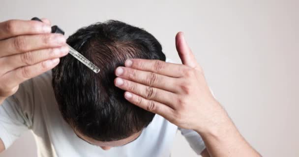 Homem Usando Minoxidil Couro Cabeludo Careca Para Tratar Perda Cabelo — Vídeo de Stock