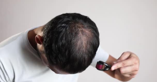 Man Applying Microneedling Hair Loss Treatment Bald Scalp Treat Male — Stok Video