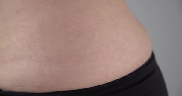 Extreme Close White Woman Showing Stretchmarks All Her Bare Waistline — Stock videók