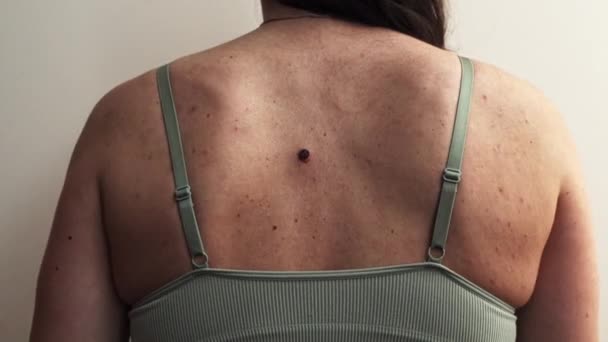 Problematic Skin Back Young Woman Multiple Small Birthmarks Bumps Skin — Vídeo de Stock