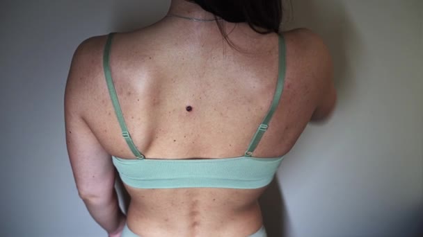Woman Back Covered Acne Pimples Skin Problems Dermatology — Stock videók