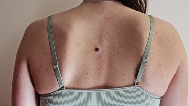 Προβληματικό Δέρμα Πλάτη Μιας Νεαρής Γυναίκας Πολλαπλά Μικρά Σημάδια Και — Αρχείο Βίντεο