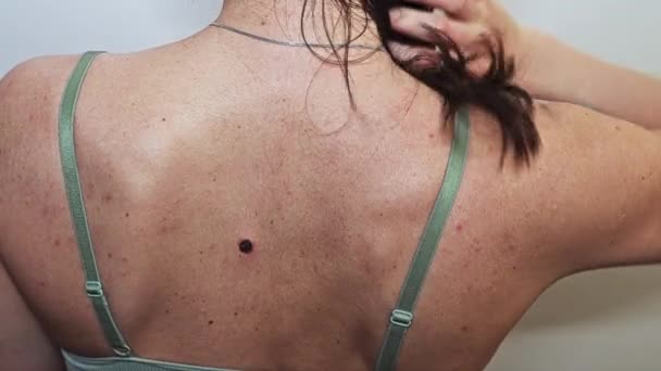 Προβληματικό Δέρμα Επιθεώρηση Της Πλάτης Των Γυναικών Κοντινό Πλάνο — Αρχείο Βίντεο