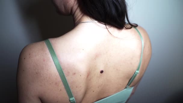 Problematic Skin Back Young Woman Multiple Small Birthmarks Bumps Skin — Stockvideo