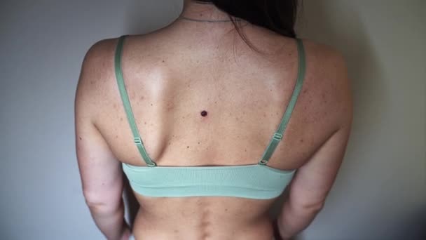 問題のある皮膚 1つの大きな脂漏性角質症と皮膚の上に複数の小さなあざやバンプを持つ若い女性の背中 — ストック動画