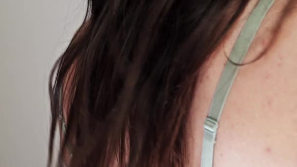 Πλάτη Μιας Νεαρής Γυναίκας Πολλαπλά Μικρά Σημάδια Στο Δέρμα Μια — Αρχείο Βίντεο