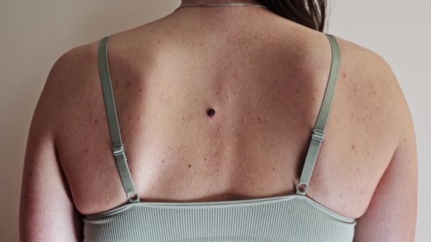 Back Young Woman Multiple Small Birthmarks Bumps Skin One Large — Stok Video
