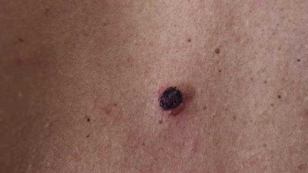 Mole Treatment Cryotherapy Dying Seborrheic Keratosis Macro Close — Stok video