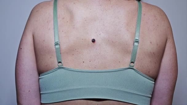 Woman Does Know What Back Young Woman Multiple Small Birthmarks — 비디오