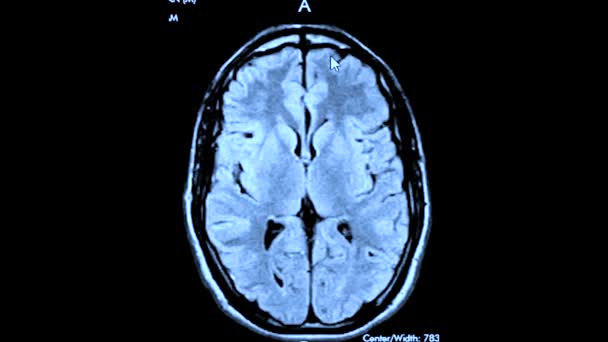 Mri Result Scan Human Brain Magneto Resonance Therapy Computer Screen — Stockvideo