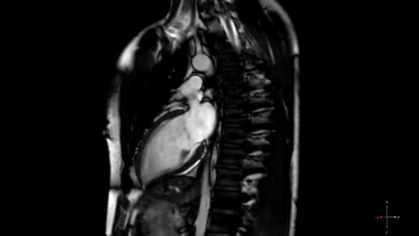 Medical Tomography Mri Scan Young Man Beating Heart Black White — 图库视频影像