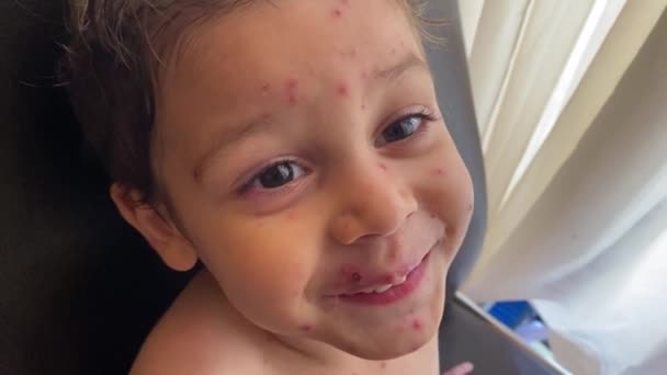 Portrait Child Chickenpox Varicella Zoster Virus Vzv Quarantined Child — Stock Video