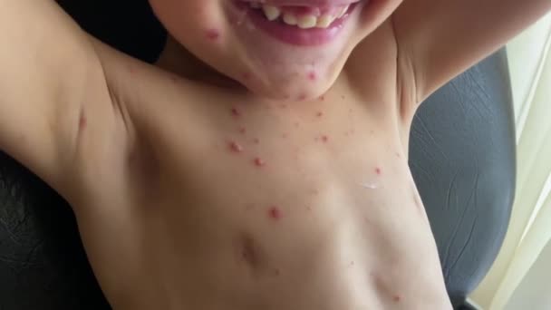 Toddler Chickenpox Ulcers Caused Varicella Zoster Virus Vzv — 비디오