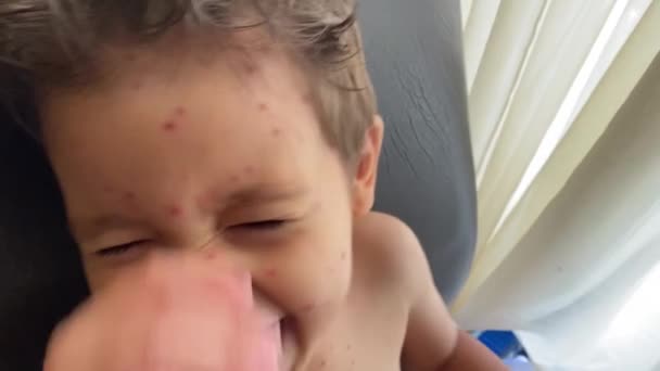Child Chickenpox Pretending Cry Close — Stock video