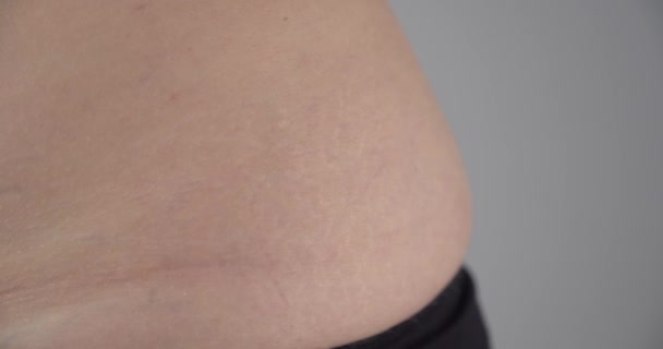 Macro Close Gimbal Shot Female Waist Stretch Marks Cellulite — Stock Video