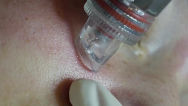 Close Aquapure Machine Being Applied Woman Cheek Facial Cleansing Vertical — Stok video