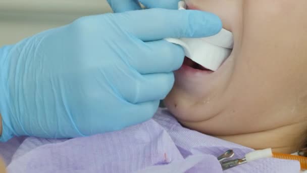 Close Little Girl Mouth Dentist Dental Check Fluoride Application — ストック動画
