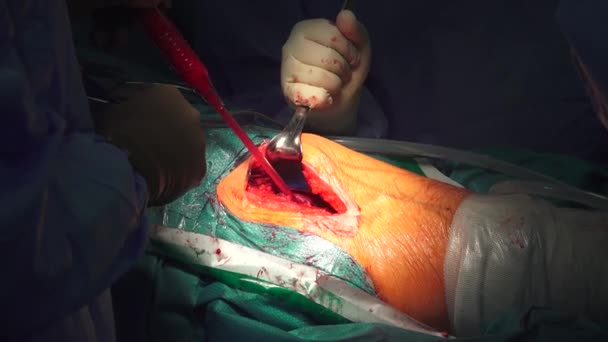 Hip Replacement Surgical Procedure Which Hip Joint Replaced Prosthetic Implant — Stockvideo