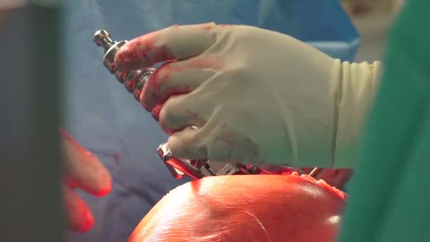 Knee Replacement Surgical Procedure Which Knee Joint Replaced Prosthetic Implant — Vídeo de Stock