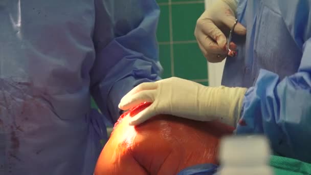 Knee Replacement Surgical Procedure Which Knee Joint Replaced Prosthetic Implant — Vídeo de Stock