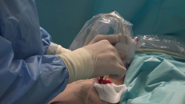 Endovenous Laser Ablation Evla Commonly Used Very Effective Minimally Invasive — Vídeo de stock