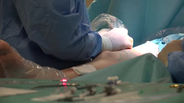 Endovenous Laser Ablation Evla Commonly Used Very Effective Minimally Invasive — Stockvideo