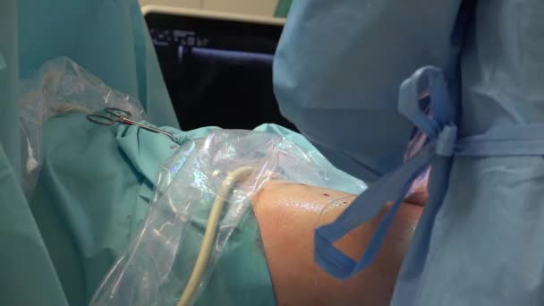 Endovenous Laser Ablation Evla Commonly Used Very Effective Minimally Invasive — Vídeo de Stock