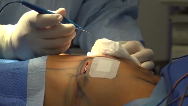 Breast Augmentation Plastic Surgery Terms Breast Implant Fat Graft Mammoplasty — Stock Video