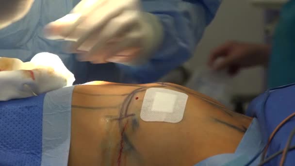 Breast Augmentation Plastic Surgery Terms Breast Implant Fat Graft Mammoplasty — Stock videók