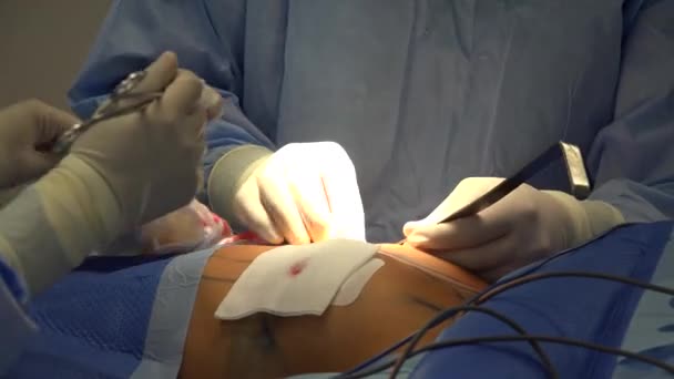 Увеличение Груди Пластическая Хирургия Грудного Импланта Маммопластика Используемая Увеличения Размера — стоковое видео