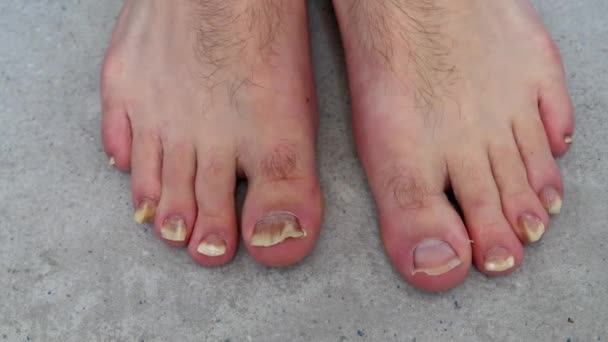 Obě Nohy Mužské Noze Plísňovou Infekcí Nehtech Nohou Které Jsou — Stock video