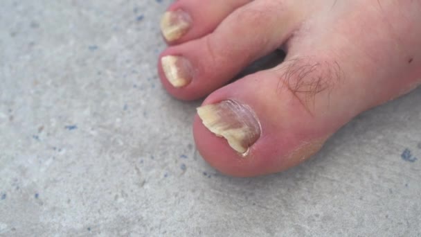 Beide Voeten Een Mannelijke Voet Met Een Schimmelinfectie Teennagels Die — Stockvideo