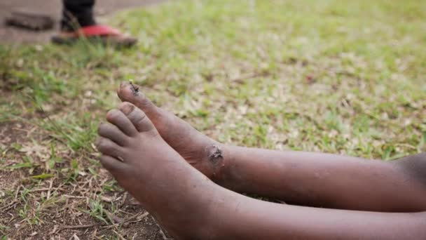 Dramatické Ubohé Africké Děti Ranami Mouchami Kolem Smutné Zastoupení Africké — Stock video