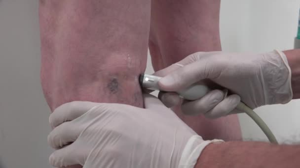 Ultraschalluntersuchung Der Krampfadern Der Unteren Extremität — Stockvideo