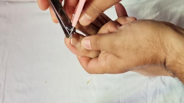 곰팡이때문에 손상된 손톱으로 자르는 의원인 세균에 굳은살 옥수수 — 비디오