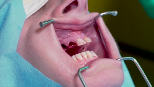 Dişçide Dişlerini Çektiren Bir Kadın — Stok video