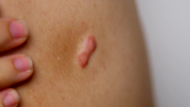 Keloid Bekas Luka Pada Orang — Stok Video