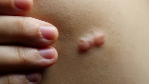 Person Touches Keyloid Scar Skin — Stock Video