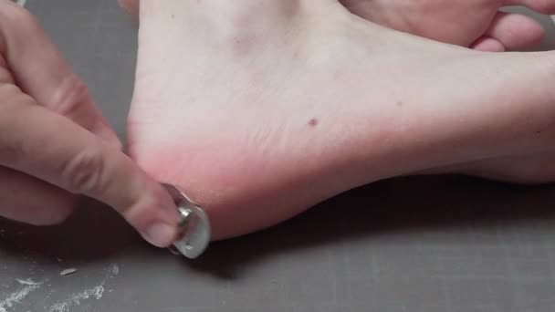 Man Removing Corn Callus His Feet Using Razor File Masculine — Stock Video