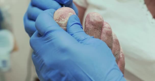 Podiatry Treating Fungus Damaged Big Toe Nail Right Foot — Stock Video