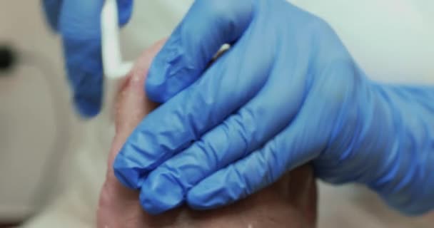 Podiatry Scraping Dead Skin Calluses Right Foot Big Toe — Stock Video