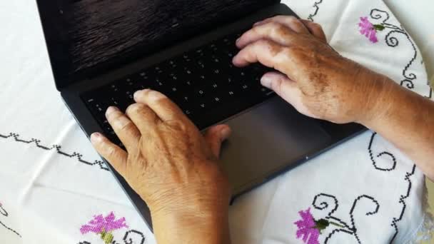 Mulher Com Vitiligo Suas Mãos Trabalhando Computador — Vídeo de Stock