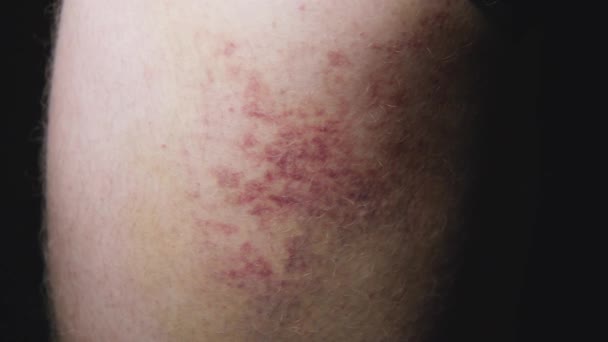 Grande Ecchymose Colorée Sur Jambe Douloureuse Cicatrisation — Video